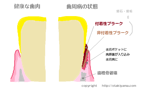 介護現場での口腔ケア　吐息のニオイ（口臭）の原因と対策方法