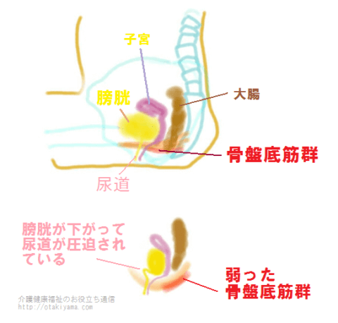 弱った骨盤底筋の図