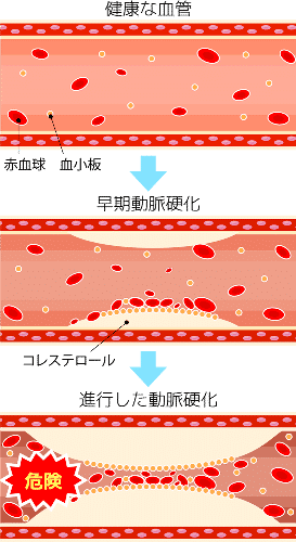 悪玉コレステロールと高血圧、動脈硬化